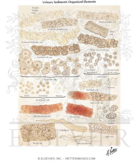 Urinary Sediment: Organized Elements