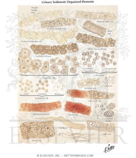 Urinary Sediment: Organized Elements