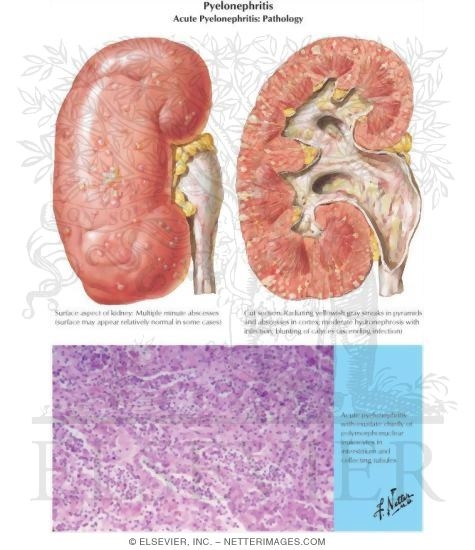 Pyelonephritis adult image