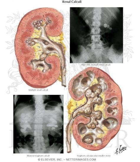 Watermarked preview of unlabeled image: Renal Calculi