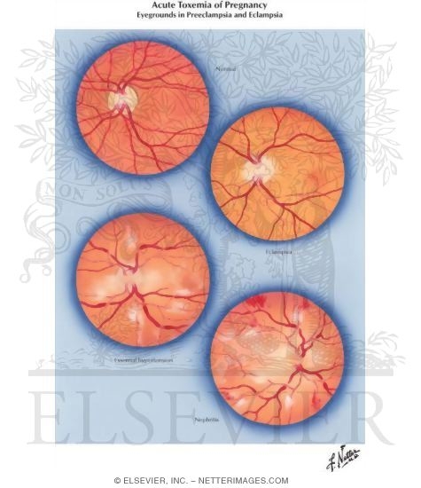 Acute Toxemia of Pregnancy II - Eyegrounds in Preeclampsia and Eclampsia