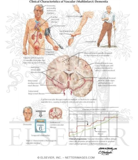 Watermarked preview of unlabeled image: Clinical Characteristics of Vascular (Multiinfarct) Dementia