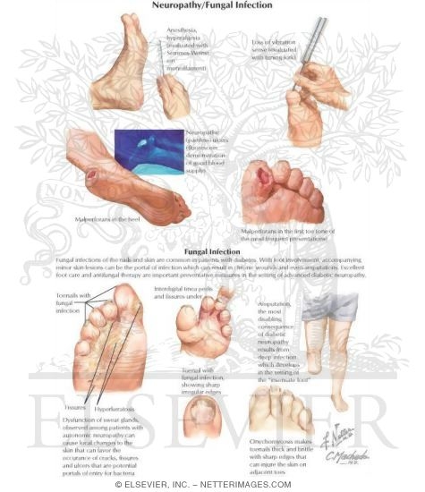 Diabetes Mellitus and Its Complications: Neuropathy and Fungal Infection