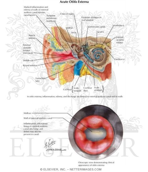 Acute Otitis Externa