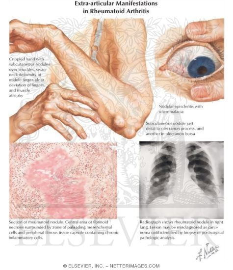 Extra-articular Manifestations in Rheumatoid Arthritis