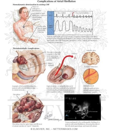 Complications of Atrial Fibrillation