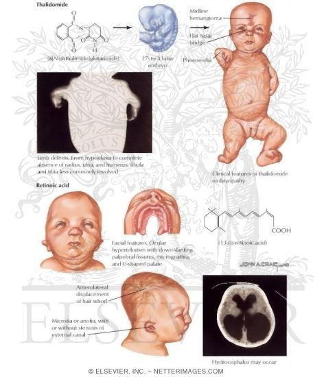 Drug-Induced Embryopathies
