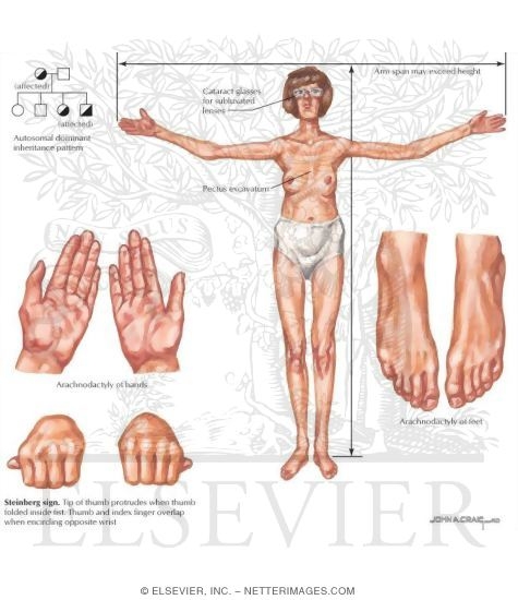 Marfan Syndrome