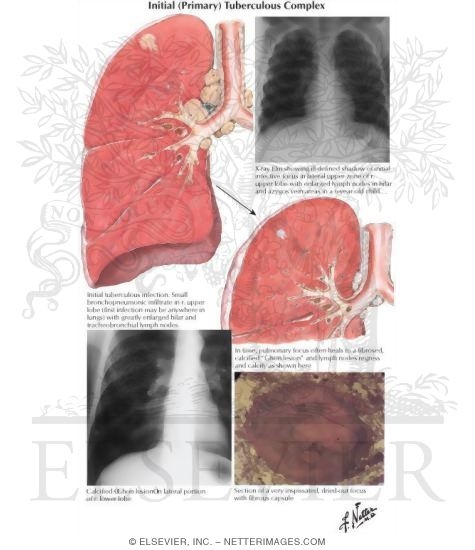 Watermarked preview of unlabeled image: Initial (Primary) Tuberculous Complex
