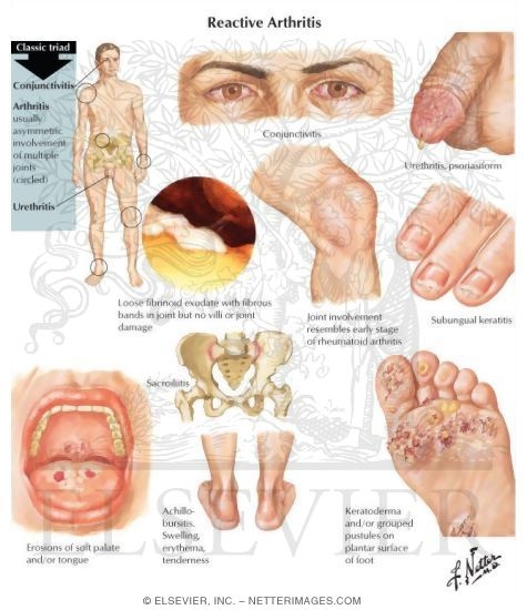 Reactive Arthritis (formerly Reiter's Syndrome)