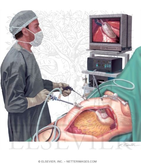 Watermarked preview of unlabeled image: Laparoscopy (Peritoneoscopy)