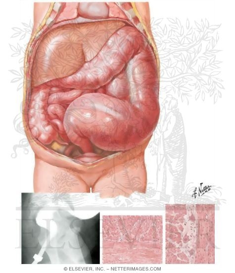 Watermarked preview of unlabeled image: Megacolon (Hirschsprung Disease)