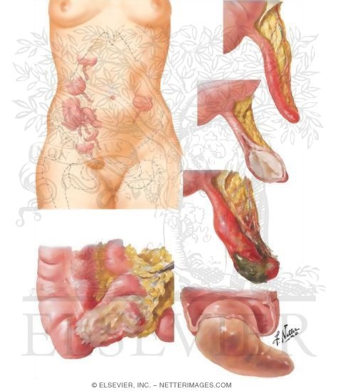 Watermarked preview of unlabeled image: Diseases of the Appendix: Inflammation, Mucucele, and Tumors