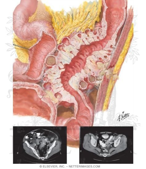 Diverticulitis, With CT Scans Showing a Wall and Diverticula