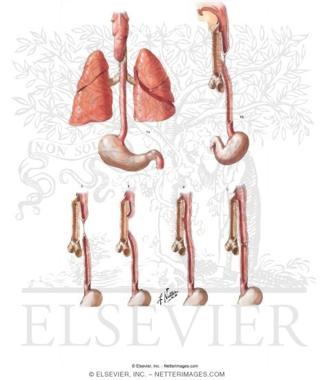 Congenital Anomalies of Esophagus 