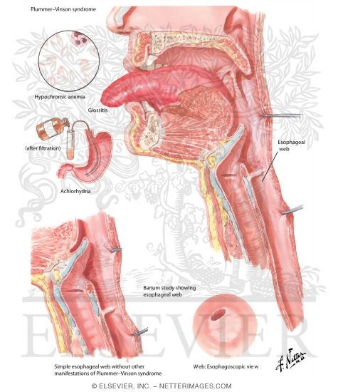 plummer vinson syndrome