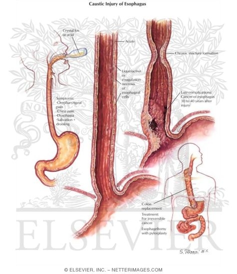 Caustic Injury of the Esophagus