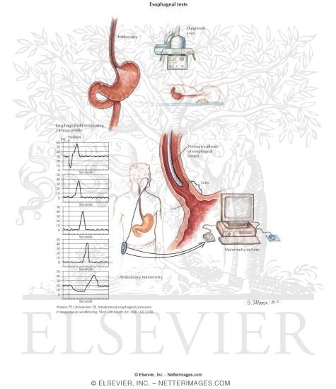 Watermarked preview of unlabeled image: Esophageal Tests for Gastroesophageal Reflux Disease (GERD)