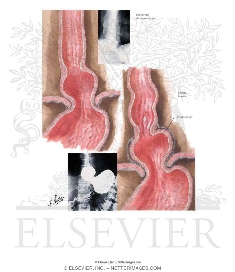 Watermarked preview of labeled image: Thoracic Stomach I - Short Esophagus, Sliding Hernia