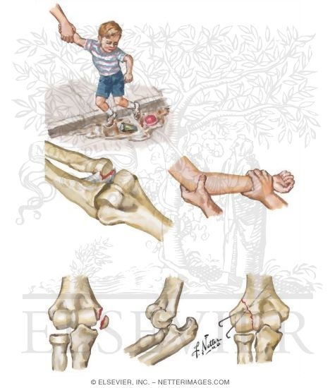 Watermarked preview of unlabeled image: Elbow Injury in Children