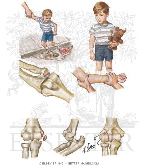 Elbow Injuries in Children