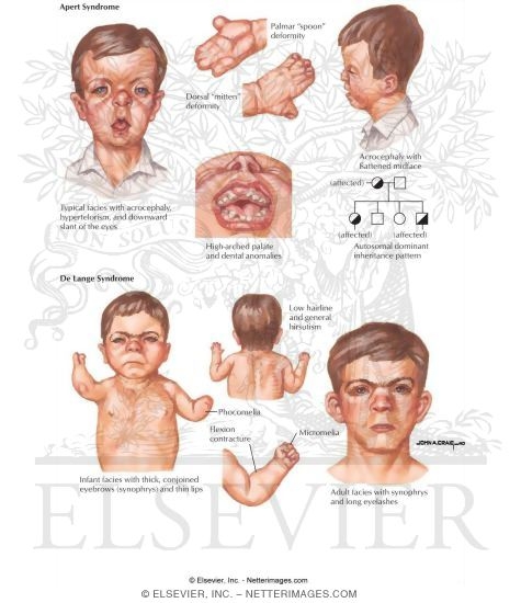 Watermarked preview of labeled image: Apert and DeLange Syndromes