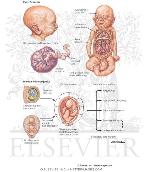 Potter Sequence
Oligohydramnios