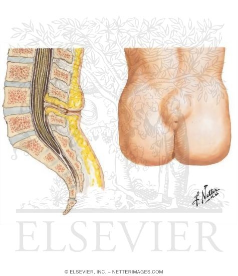 Watermarked preview of unlabeled image: Spinal Dysraphism