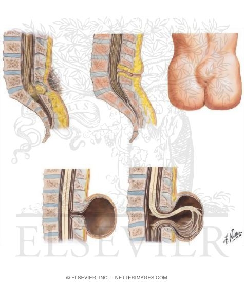 Defects of the Spinal Cord and Vertebral Column