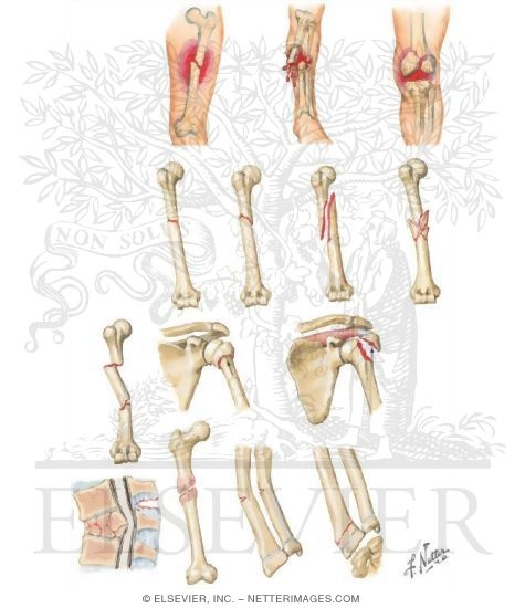 Watermarked preview of unlabeled image: Fractures