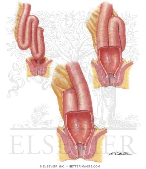 Ileal Pouch Anal Anastomosis (IPAA) and Pouchitis