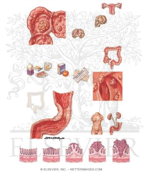 Neoplasms of the Large Bowel: Colon Polyps