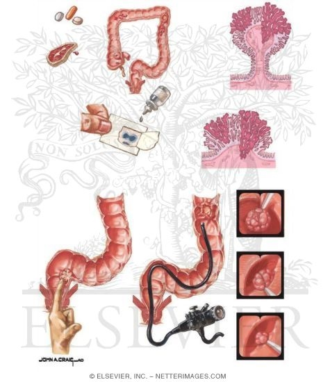 Watermarked preview of unlabeled image: Neoplasms of the Large Bowel: Screening and Treatment of Colon Polyps