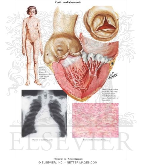 Cystic Medial Necrosis of the Aorta