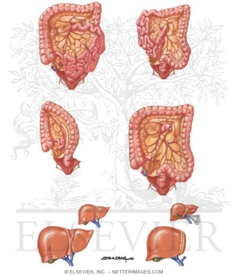Watermarked preview of unlabeled image: Colon Cancer: Staging, Treatment, and Outcome