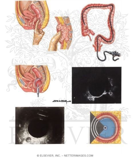 Watermarked preview of unlabeled image: Rectal Cancer