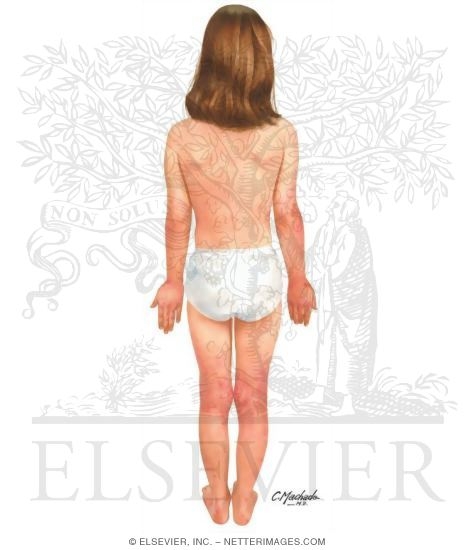 Watermarked preview of unlabeled image: Child With Atopic Dermatitis - Dorsal View