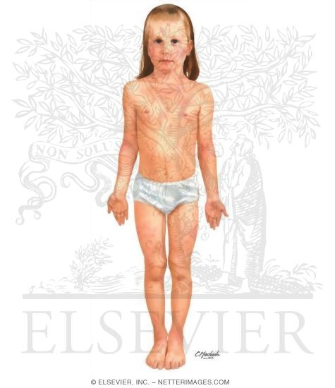 Watermarked preview of unlabeled image: Child With Atopic Dermatitis - Frontal View