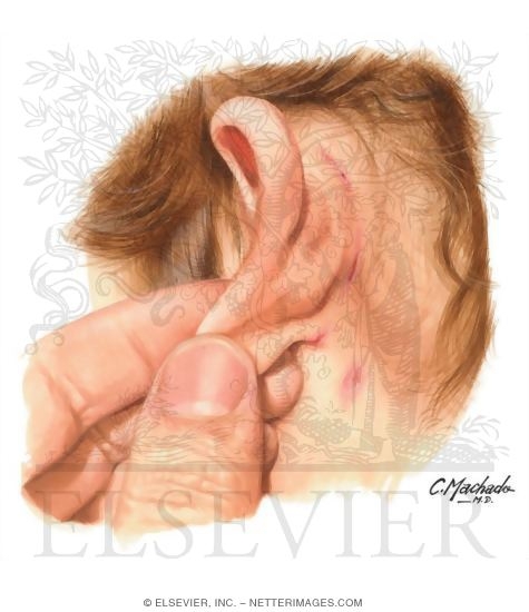 Postauricular Fissures