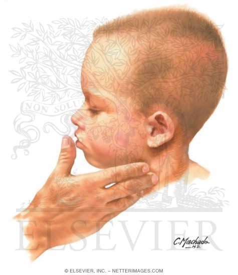 Lymphadenopathy In a Child With Atopic Dermatitis