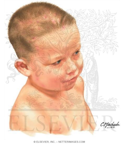 Watermarked preview of unlabeled image: Scalp Dermatitis In a Child (Scalp Cap)