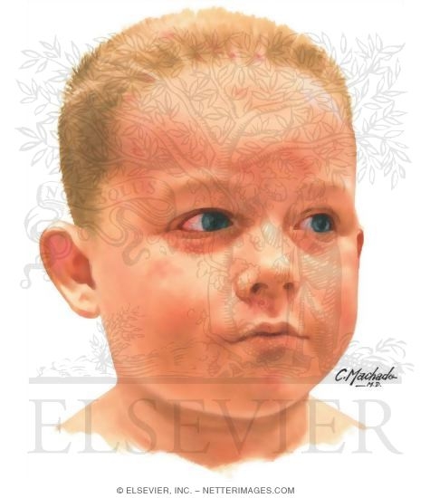 Conjunctivitis Eyelid Inflammation