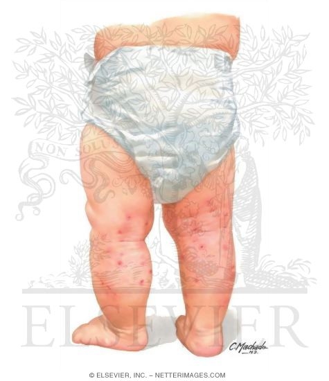 Watermarked preview of unlabeled image: Popliteal Lesions In an Infant