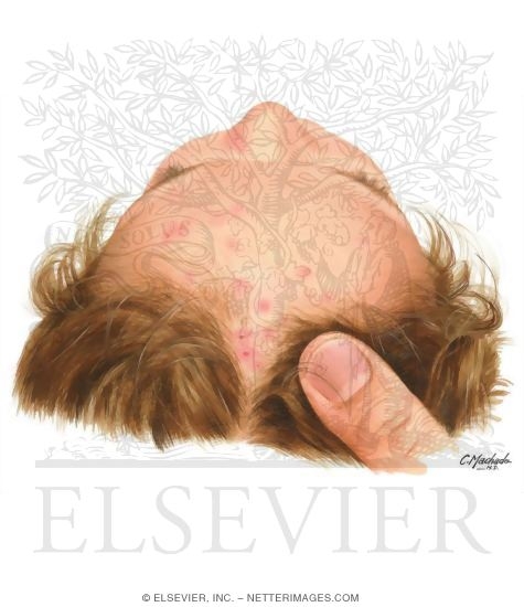 Atopic Dermatitis of the Scalp
