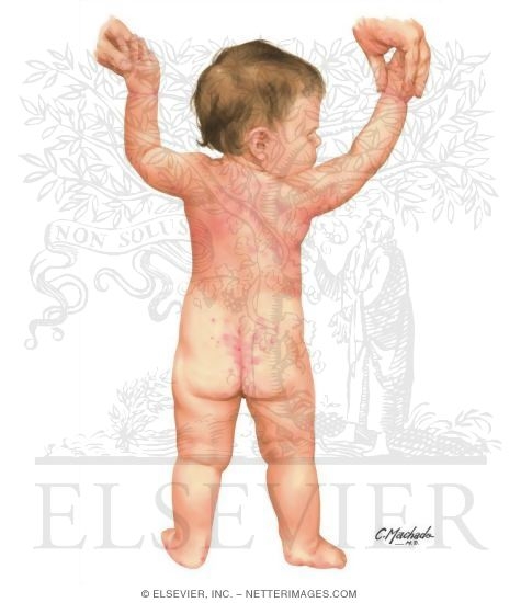 Child With Scabies - Dorsal View