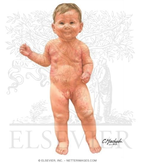 Watermarked preview of unlabeled image: Child With Scabies - Frontal View