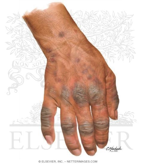 Contact dermatitis dissertation picture