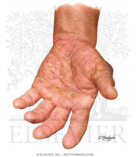 Watermarked preview of unlabeled image: Allergic Contact Dermatitis