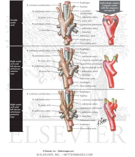 Aortic Arch Anomalies