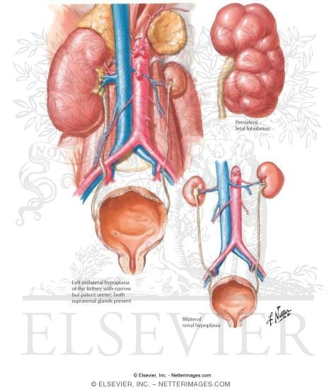 Renal Hypoplasia